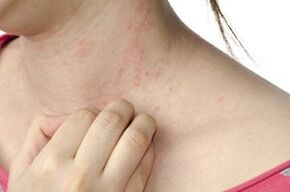 Rashes from parasites